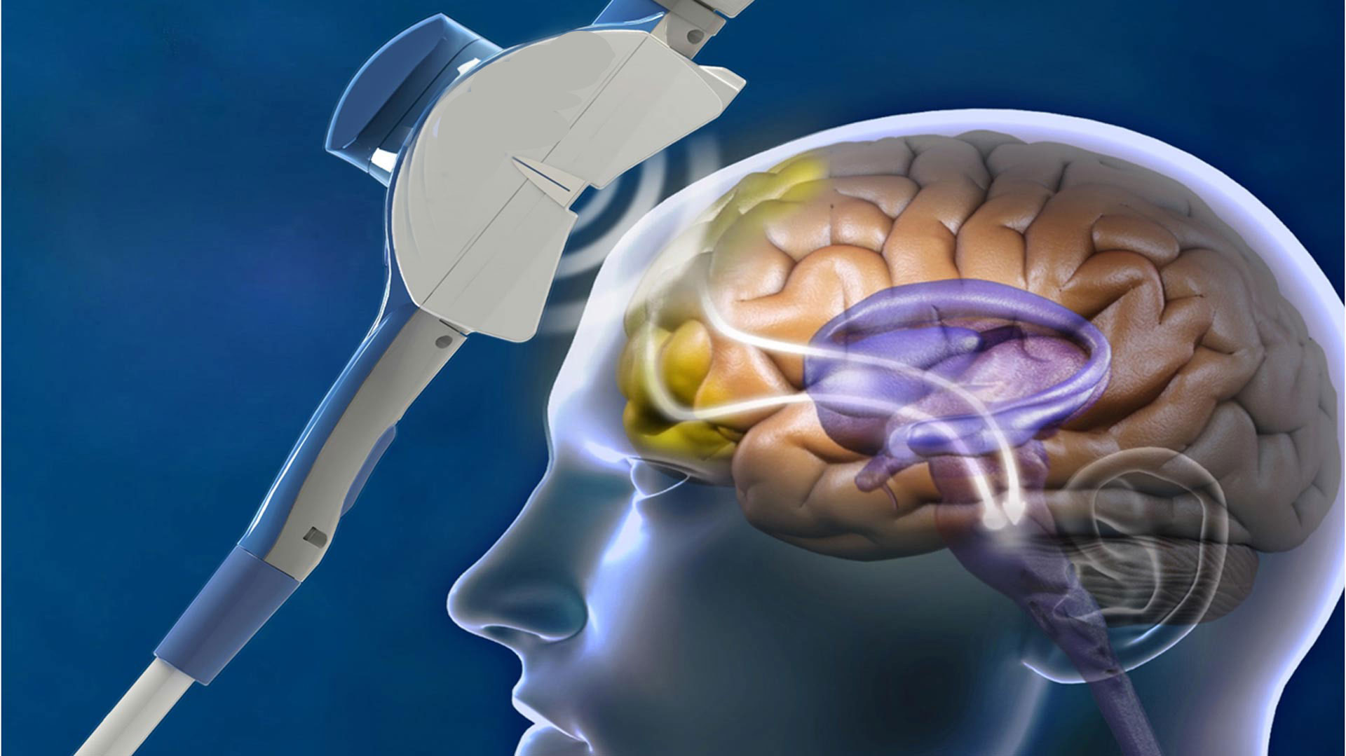 TransCranial Magnetic Stimulation In San Diego - Solara